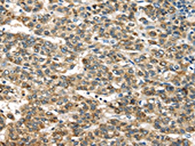The image on the left is immunohistochemistry of paraffin-embedded Human liver cancer tissue using CSB-PA556193(TNFAIP2 Antibody) at dilution 1/40, on the right is treated with fusion protein. (Original magnification: ×200)
