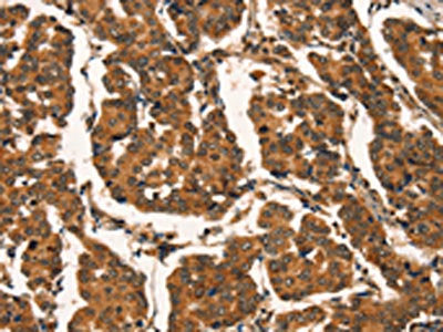 The image on the left is immunohistochemistry of paraffin-embedded Human breast cancer tissue using CSB-PA556194(CTNNBIP1 Antibody) at dilution 1/20, on the right is treated with fusion protein. (Original magnification: ×200)
