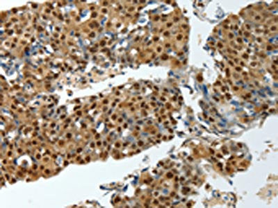 The image on the left is immunohistochemistry of paraffin-embedded Human breast cancer tissue using CSB-PA556296(YBX1 Antibody) at dilution 1/15, on the right is treated with synthetic peptide. (Original magnification: ×200)