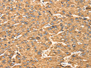 The image on the left is immunohistochemistry of paraffin-embedded Human liver cancer tissue using CSB-PA556658(MAPK7 Antibody) at dilution 1/20, on the right is treated with fusion protein. (Original magnification: ×200)