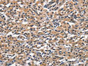 The image on the left is immunohistochemistry of paraffin-embedded Human thyroid cancer tissue using CSB-PA556674(OLR1 Antibody) at dilution 1/25, on the right is treated with synthetic peptide. (Original magnification: ×200)