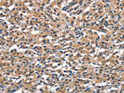 The image on the left is immunohistochemistry of paraffin-embedded Human thyroid cancer tissue using CSB-PA556674(OLR1 Antibody) at dilution 1/25, on the right is treated with synthetic peptide. (Original magnification: ×200)
