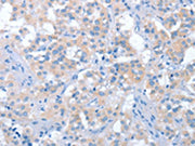 The image on the left is immunohistochemistry of paraffin-embedded Human thyroid cancer tissue using CSB-PA556755(IRAK3 Antibody) at dilution 1/45, on the right is treated with fusion protein. (Original magnification: ×200)
