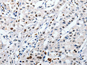 The image on the left is immunohistochemistry of paraffin-embedded Human lung cancer tissue using CSB-PA556911(HSPA1A Antibody) at dilution 1/60, on the right is treated with fusion protein. (Original magnification: ×200)