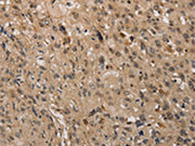 The image on the left is immunohistochemistry of paraffin-embedded Human esophagus cancer tissue using CSB-PA557005(KDM4A Antibody) at dilution 1/40, on the right is treated with synthetic peptide. (Original magnification: ×200)
