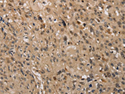 The image on the left is immunohistochemistry of paraffin-embedded Human esophagus cancer tissue using CSB-PA557005(KDM4A Antibody) at dilution 1/40, on the right is treated with synthetic peptide. (Original magnification: ×200)