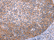 The image on the left is immunohistochemistry of paraffin-embedded Human cervical cancer tissue using CSB-PA557036(FUT8 Antibody) at dilution 1/20, on the right is treated with synthetic peptide. (Original magnification: ×200)