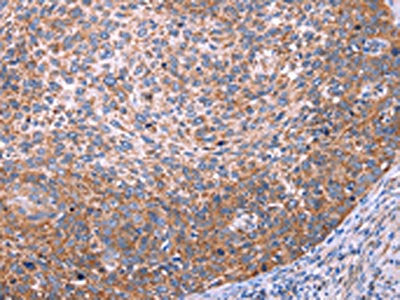 The image on the left is immunohistochemistry of paraffin-embedded Human cervical cancer tissue using CSB-PA557036(FUT8 Antibody) at dilution 1/20, on the right is treated with synthetic peptide. (Original magnification: ×200)