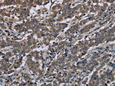 The image on the left is immunohistochemistry of paraffin-embedded Human liver cancer tissue using CSB-PA557048(MAPKAPK2 Antibody) at dilution 1/20, on the right is treated with synthetic peptide. (Original magnification: ×200)