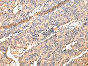 The image on the left is immunohistochemistry of paraffin-embedded Human prostate cancer tissue using CSB-PA557065(SDCBP Antibody) at dilution 1/40, on the right is treated with fusion protein. (Original magnification: ×200)