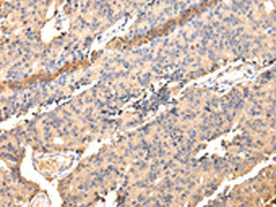 The image on the left is immunohistochemistry of paraffin-embedded Human prostate cancer tissue using CSB-PA557065(SDCBP Antibody) at dilution 1/40, on the right is treated with fusion protein. (Original magnification: ×200)