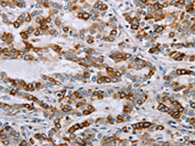 The image on the left is immunohistochemistry of paraffin-embedded Human liver cancer tissue using CSB-PA557232(NMT1 Antibody) at dilution 1/45, on the right is treated with synthetic peptide. (Original magnification: ×200)