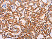 The image on the left is immunohistochemistry of paraffin-embedded Human thyroid cancer tissue using CSB-PA557372(ADAMTS17 Antibody) at dilution 1/60, on the right is treated with synthetic peptide. (Original magnification: ×200)