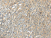 The image on the left is immunohistochemistry of paraffin-embedded Human ovarian cancer tissue using CSB-PA557436(TSPYL6 Antibody) at dilution 1/20, on the right is treated with synthetic peptide. (Original magnification: ×200)