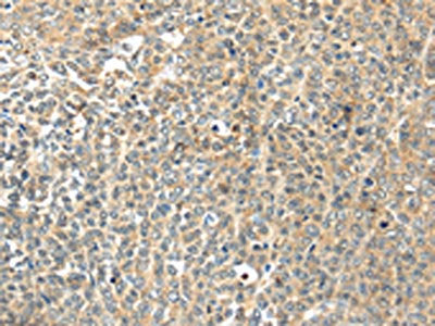 The image on the left is immunohistochemistry of paraffin-embedded Human ovarian cancer tissue using CSB-PA557436(TSPYL6 Antibody) at dilution 1/20, on the right is treated with synthetic peptide. (Original magnification: ×200)