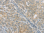 The image on the left is immunohistochemistry of paraffin-embedded Human gastic cancer tissue using CSB-PA557580(PKD1 Antibody) at dilution 1/40, on the right is treated with synthetic peptide. (Original magnification: ×200)