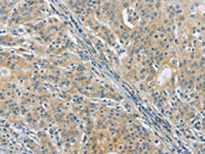The image on the left is immunohistochemistry of paraffin-embedded Human gastic cancer tissue using CSB-PA557580(PKD1 Antibody) at dilution 1/40, on the right is treated with synthetic peptide. (Original magnification: ×200)