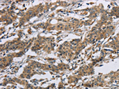 The image on the left is immunohistochemistry of paraffin-embedded Human gastic cancer tissue using CSB-PA557600(SYN2 Antibody) at dilution 1/40, on the right is treated with synthetic peptide. (Original magnification: ×200)