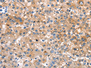 The image on the left is immunohistochemistry of paraffin-embedded Human liver cancer tissue using CSB-PA557863(CRHR2 Antibody) at dilution 1/25, on the right is treated with synthetic peptide. (Original magnification: ×200)