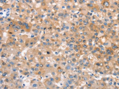 The image on the left is immunohistochemistry of paraffin-embedded Human liver cancer tissue using CSB-PA557863(CRHR2 Antibody) at dilution 1/25, on the right is treated with synthetic peptide. (Original magnification: ×200)