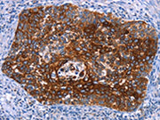 The image on the left is immunohistochemistry of paraffin-embedded Human cervical cancer tissue using CSB-PA557996(MAP3K2 Antibody) at dilution 1/15, on the right is treated with synthetic peptide. (Original magnification: ×200)