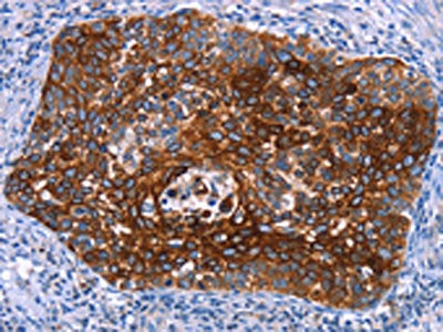 The image on the left is immunohistochemistry of paraffin-embedded Human cervical cancer tissue using CSB-PA557996(MAP3K2 Antibody) at dilution 1/15, on the right is treated with synthetic peptide. (Original magnification: ×200)