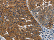 The image on the left is immunohistochemistry of paraffin-embedded Human ovarian cancer tissue using CSB-PA558079(PDCD2 Antibody) at dilution 1/50, on the right is treated with synthetic peptide. (Original magnification: ×200)