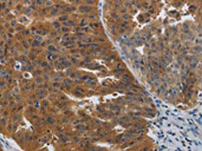 The image on the left is immunohistochemistry of paraffin-embedded Human ovarian cancer tissue using CSB-PA558079(PDCD2 Antibody) at dilution 1/50, on the right is treated with synthetic peptide. (Original magnification: ×200)