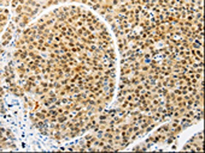 The image on the left is immunohistochemistry of paraffin-embedded Human liver cancer tissue using CSB-PA558089(RAN Antibody) at dilution 1/10, on the right is treated with synthetic peptide. (Original magnification: ×200)