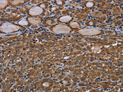 The image on the left is immunohistochemistry of paraffin-embedded Human thyroid cancer tissue using CSB-PA558294(GJB4 Antibody) at dilution 1/40, on the right is treated with synthetic peptide. (Original magnification: ×200)