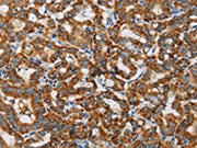 The image on the left is immunohistochemistry of paraffin-embedded Human thyroid cancer tissue using CSB-PA558364(MRPL28 Antibody) at dilution 1/20, on the right is treated with fusion protein. (Original magnification: ×200)