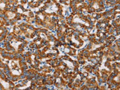 The image on the left is immunohistochemistry of paraffin-embedded Human thyroid cancer tissue using CSB-PA558364(MRPL28 Antibody) at dilution 1/20, on the right is treated with fusion protein. (Original magnification: ×200)