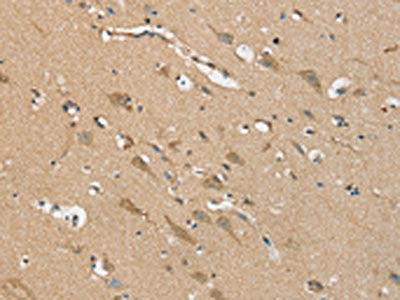 The image on the left is immunohistochemistry of paraffin-embedded Human brain tissue using CSB-PA558433(NES Antibody) at dilution 1/20, on the right is treated with synthetic peptide. (Original magnification: ×200)