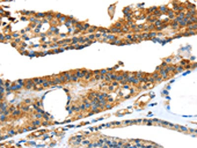 The image on the left is immunohistochemistry of paraffin-embedded Human thyroid cancer tissue using CSB-PA558561(SNAI3 Antibody) at dilution 1/20, on the right is treated with fusion protein. (Original magnification: ×200)