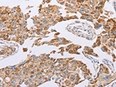 The image on the left is immunohistochemistry of paraffin-embedded Human lung cancer tissue using CSB-PA558643(GUCY1A3 Antibody) at dilution 1/30, on the right is treated with fusion protein. (Original magnification: ×200)