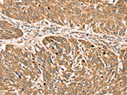 The image on the left is immunohistochemistry of paraffin-embedded Human lung cancer tissue using CSB-PA558649(RPLP2 Antibody) at dilution 1/35, on the right is treated with fusion protein. (Original magnification: ×200)