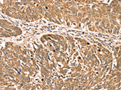 The image on the left is immunohistochemistry of paraffin-embedded Human lung cancer tissue using CSB-PA558649(RPLP2 Antibody) at dilution 1/35, on the right is treated with fusion protein. (Original magnification: ×200)