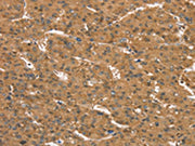 The image on the left is immunohistochemistry of paraffin-embedded Human liver cancer tissue using CSB-PA558771(CD97 Antibody) at dilution 1/35, on the right is treated with synthetic peptide. (Original magnification: ×200)