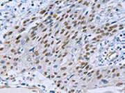 The image on the left is immunohistochemistry of paraffin-embedded Human esophagus cancer tissue using CSB-PA559356(CAPN6 Antibody) at dilution 1/15, on the right is treated with fusion protein. (Original magnification: ×200)