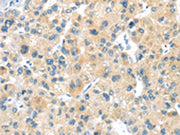 The image on the left is immunohistochemistry of paraffin-embedded Human liver cancer tissue using CSB-PA559394(LPAR1 Antibody) at dilution 1/20, on the right is treated with synthetic peptide. (Original magnification: ×200)