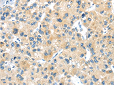 The image on the left is immunohistochemistry of paraffin-embedded Human liver cancer tissue using CSB-PA559394(LPAR1 Antibody) at dilution 1/20, on the right is treated with synthetic peptide. (Original magnification: ×200)