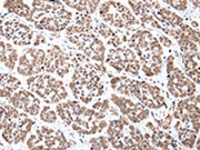 The image on the left is immunohistochemistry of paraffin-embedded Human esophagus cancer tissue using CSB-PA559486(CDX2 Antibody) at dilution 1/35, on the right is treated with synthetic peptide. (Original magnification: ×200)