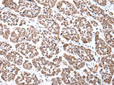 The image on the left is immunohistochemistry of paraffin-embedded Human esophagus cancer tissue using CSB-PA559486(CDX2 Antibody) at dilution 1/35, on the right is treated with synthetic peptide. (Original magnification: ×200)