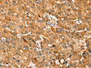 The image on the left is immunohistochemistry of paraffin-embedded Human liver cancer tissue using CSB-PA559643(TRIM62 Antibody) at dilution 1/30, on the right is treated with synthetic peptide. (Original magnification: ×200)