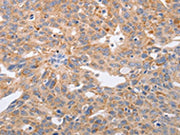 The image on the left is immunohistochemistry of paraffin-embedded Human ovarian cancer tissue using CSB-PA559752(PPP1CB Antibody) at dilution 1/40, on the right is treated with fusion protein. (Original magnification: ×200)