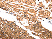 The image on the left is immunohistochemistry of paraffin-embedded Human cervical cancer tissue using CSB-PA559833(SLC39A6 Antibody) at dilution 1/30, on the right is treated with synthetic peptide. (Original magnification: ×200)