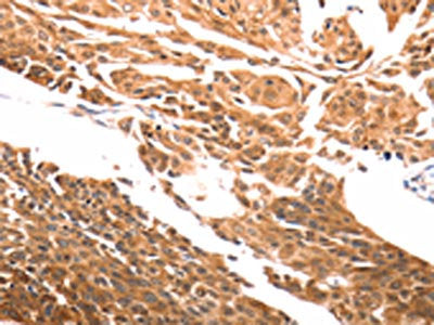 The image on the left is immunohistochemistry of paraffin-embedded Human cervical cancer tissue using CSB-PA559833(SLC39A6 Antibody) at dilution 1/30, on the right is treated with synthetic peptide. (Original magnification: ×200)