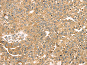 The image on the left is immunohistochemistry of paraffin-embedded Human breast cancer tissue using CSB-PA559884(SAMD3 Antibody) at dilution 1/30, on the right is treated with fusion protein. (Original magnification: ×200)