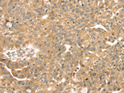 The image on the left is immunohistochemistry of paraffin-embedded Human breast cancer tissue using CSB-PA559884(SAMD3 Antibody) at dilution 1/30, on the right is treated with fusion protein. (Original magnification: ×200)