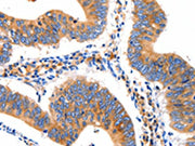The image on the left is immunohistochemistry of paraffin-embedded Human colon cancer tissue using CSB-PA559950(GRM1 Antibody) at dilution 1/10, on the right is treated with synthetic peptide. (Original magnification: ×200)